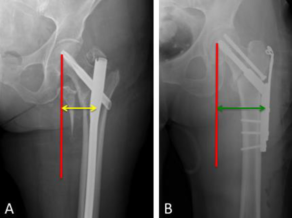 髋部骨折：相关解剖学、分型、治疗、骨折的生物力学，一文讲清！
