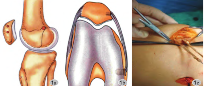 【手术技术】内侧髌股韧带重建术治疗复发性髌骨脱位