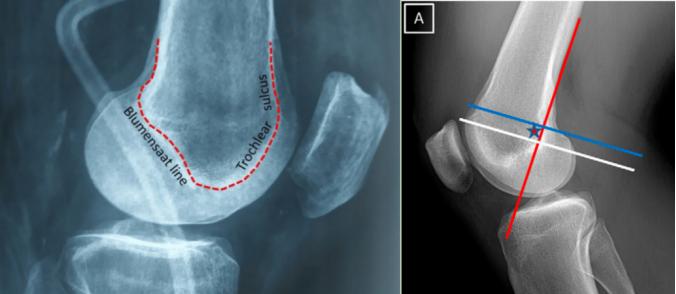 【手术技术】内侧髌股韧带重建术治疗复发性髌骨脱位