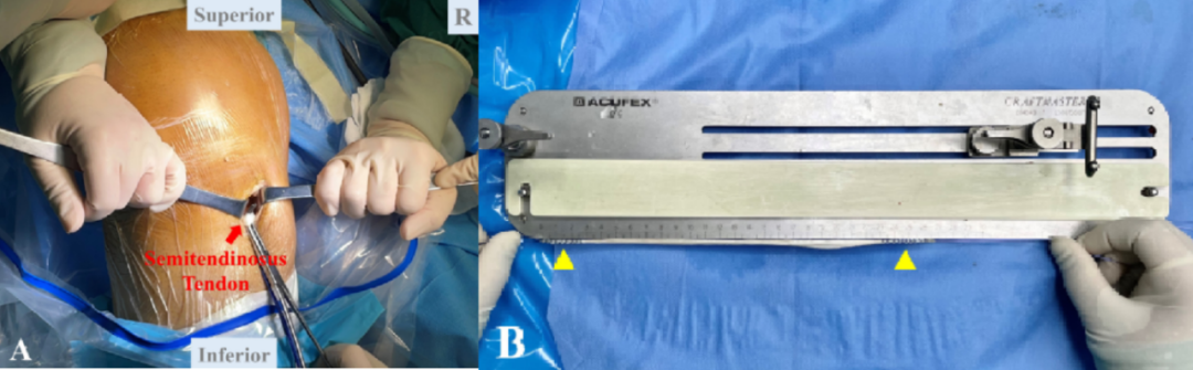 【手术技术】内侧髌股韧带重建术治疗复发性髌骨脱位