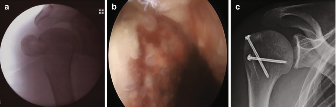 图文详解：肱骨大结节骨折的关节镜治疗