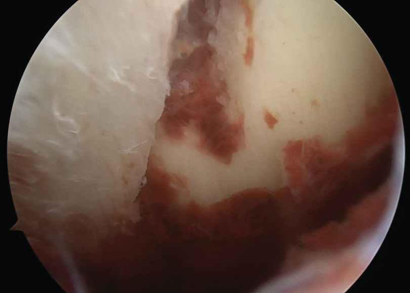 图文详解：肱骨大结节骨折的关节镜治疗