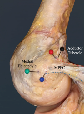 【手术技术】内侧髌股韧带重建术治疗复发性髌骨脱位