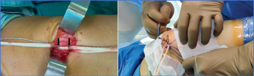 【手术技术】内侧髌股韧带重建术治疗复发性髌骨脱位