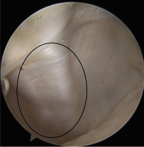 【手术技术】内侧髌股韧带重建术治疗复发性髌骨脱位