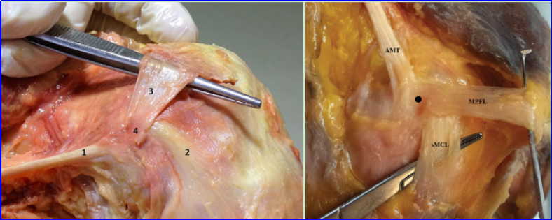 【手术技术】内侧髌股韧带重建术治疗复发性髌骨脱位