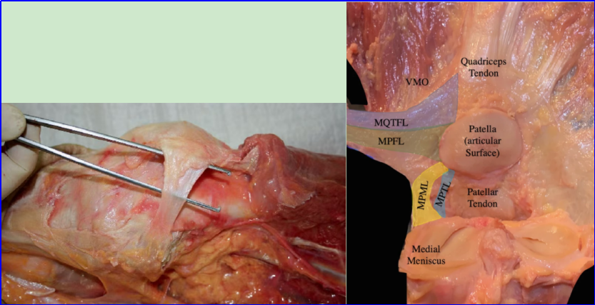 【手术技术】内侧髌股韧带重建术治疗复发性髌骨脱位