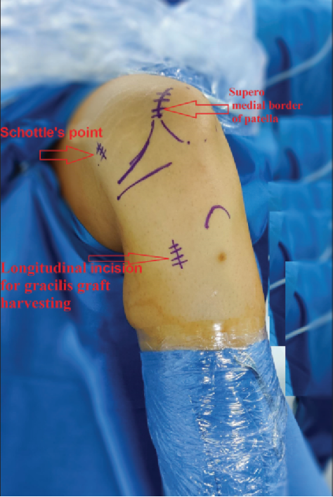 【手术技术】内侧髌股韧带重建术治疗复发性髌骨脱位