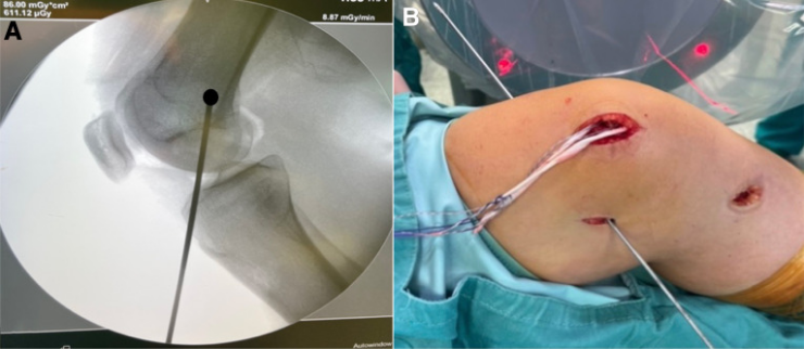 【手术技术】内侧髌股韧带重建术治疗复发性髌骨脱位