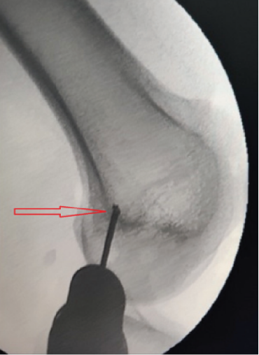 【手术技术】内侧髌股韧带重建术治疗复发性髌骨脱位
