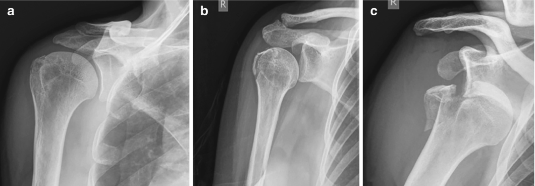 图文详解：肱骨大结节骨折的关节镜治疗