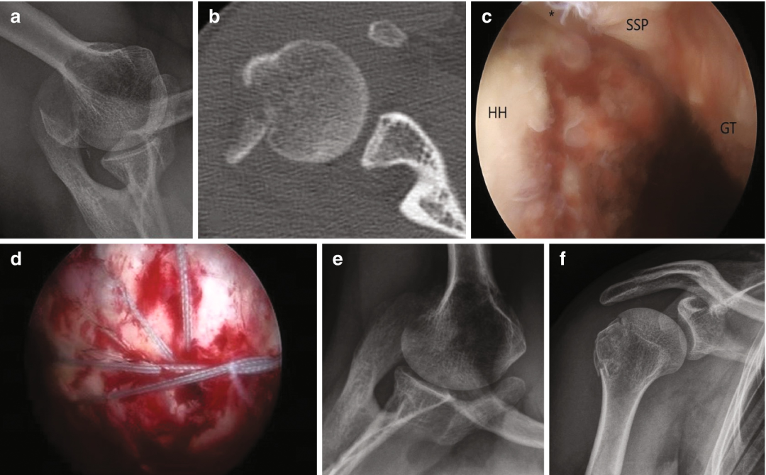 图文详解：肱骨大结节骨折的关节镜治疗