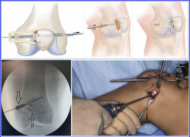 【手术技术】内侧髌股韧带重建术治疗复发性髌骨脱位