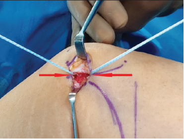 【手术技术】内侧髌股韧带重建术治疗复发性髌骨脱位