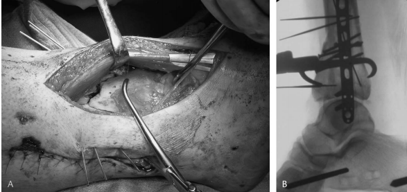 步步为“赢”：Pilon骨折前外侧入路手术全流程与关键技巧