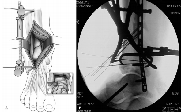 步步为“赢”：Pilon骨折前外侧入路手术全流程与关键技巧