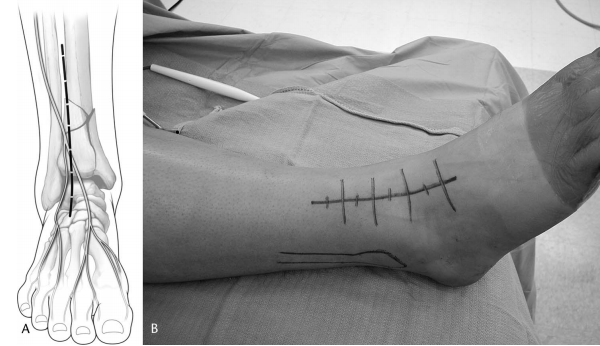 步步为“赢”：Pilon骨折前外侧入路手术全流程与关键技巧