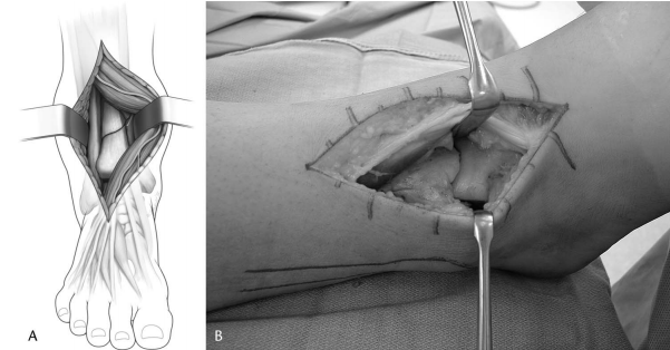 步步为“赢”：Pilon骨折前外侧入路手术全流程与关键技巧