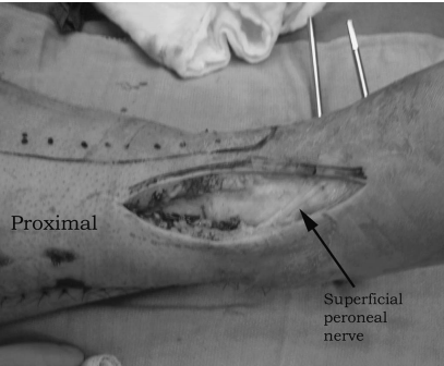 步步为“赢”：Pilon骨折前外侧入路手术全流程与关键技巧