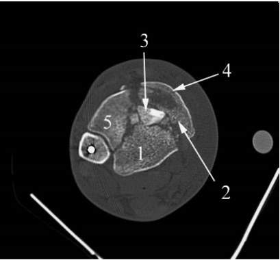步步为“赢”：Pilon骨折前外侧入路手术全流程与关键技巧