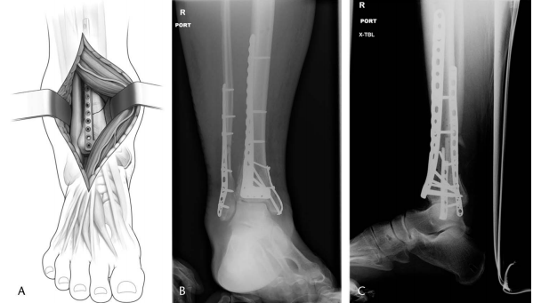 步步为“赢”：Pilon骨折前外侧入路手术全流程与关键技巧