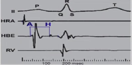 心律解码丨房室结折返性心动过速的心电图特点与机制
