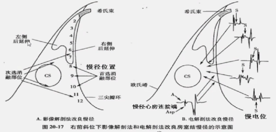 心律解码丨房室结折返性心动过速的心电图特点与机制