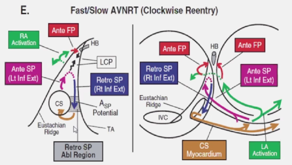 心律解码丨房室结折返性心动过速的心电图特点与机制