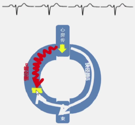 心律解码丨房室结折返性心动过速的心电图特点与机制