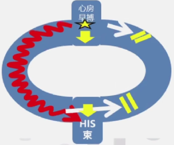 心律解码丨房室结折返性心动过速的心电图特点与机制