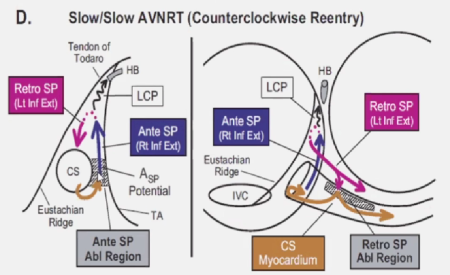 心律解码丨房室结折返性心动过速的心电图特点与机制