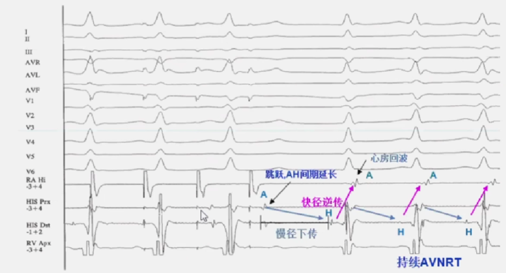 心律解码丨房室结折返性心动过速的心电图特点与机制
