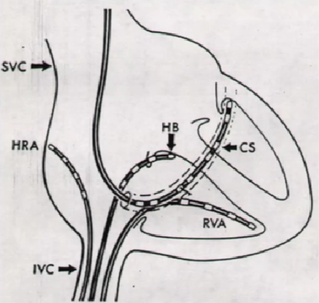 心律解码丨房室结折返性心动过速的心电图特点与机制