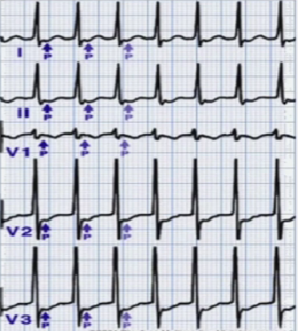 心律解码丨房室结折返性心动过速的心电图特点与机制