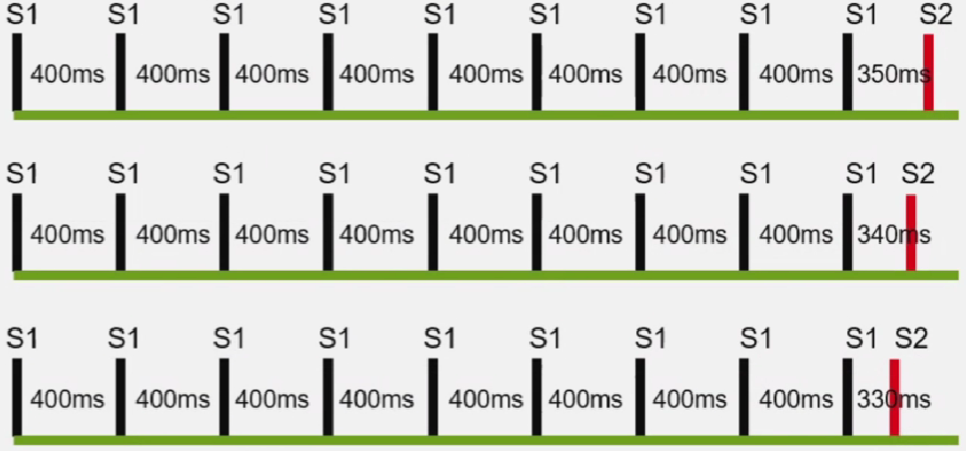 心律解码丨房室结折返性心动过速的心电图特点与机制