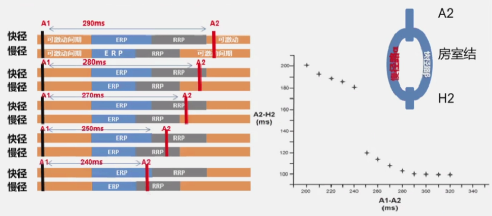 心律解码丨房室结折返性心动过速的心电图特点与机制