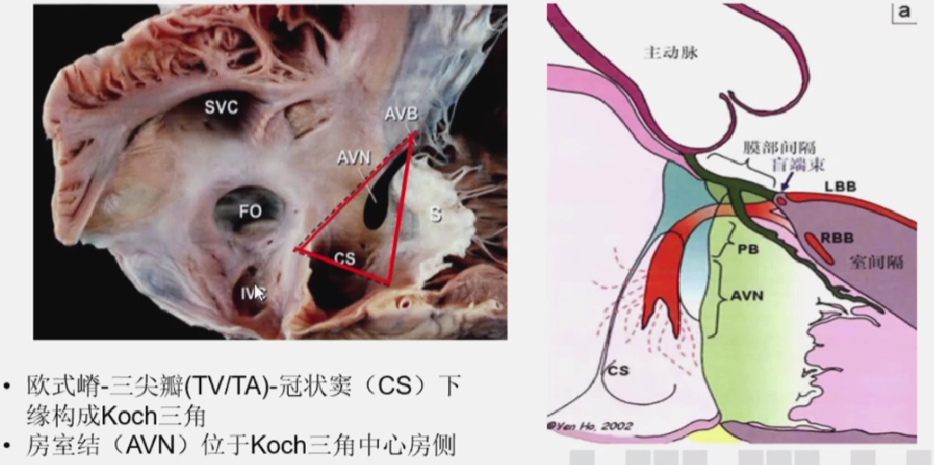 心律解码丨房室结折返性心动过速的心电图特点与机制