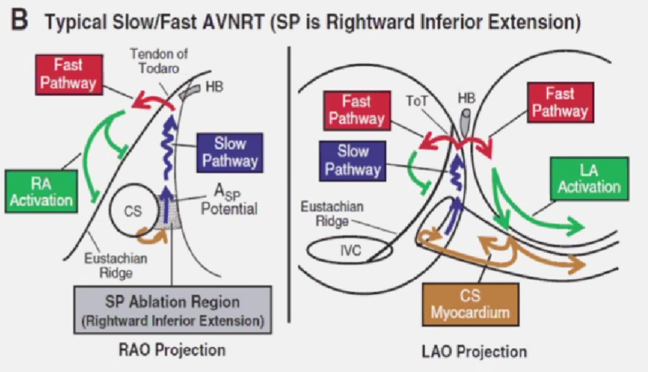 心律解码丨房室结折返性心动过速的心电图特点与机制