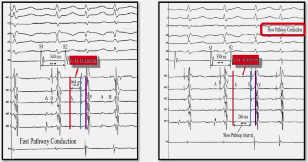 心律解码丨房室结折返性心动过速的心电图特点与机制
