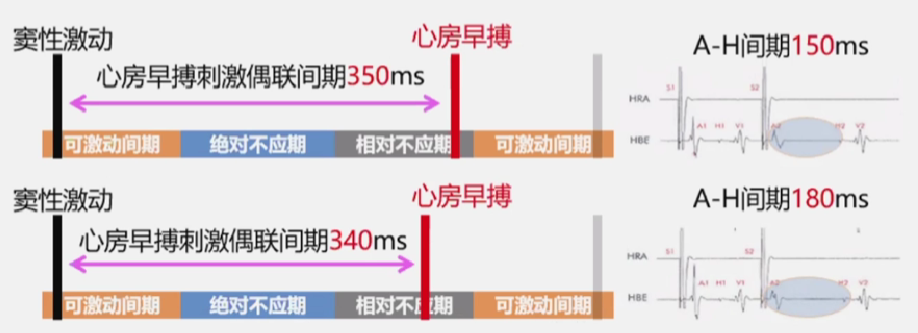 心律解码丨房室结折返性心动过速的心电图特点与机制