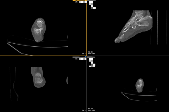 微创空心螺钉结合NICE结固定技术在治疗跟骨鸟嘴样骨折中的应用