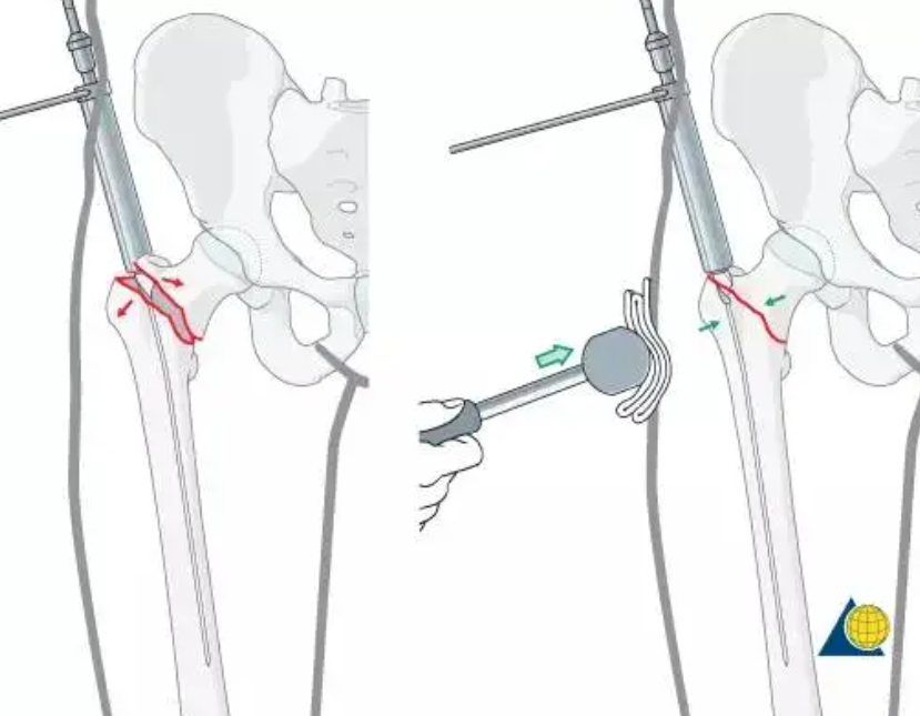 粗隆下骨折，如何巧妙使用“阻挡钉”？