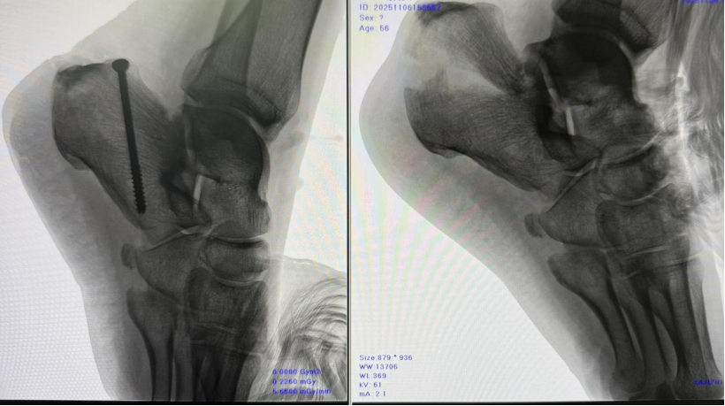 微创空心螺钉结合NICE结固定技术在治疗跟骨鸟嘴样骨折中的应用