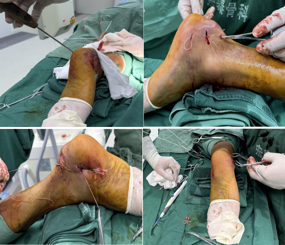 微创空心螺钉结合NICE结固定技术在治疗跟骨鸟嘴样骨折中的应用