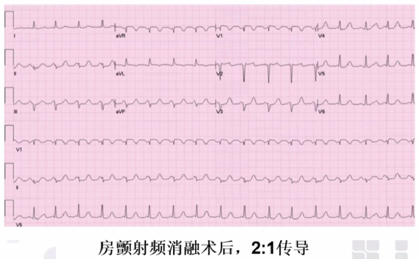 心律解码丨心房扑动的心电图特点及治疗