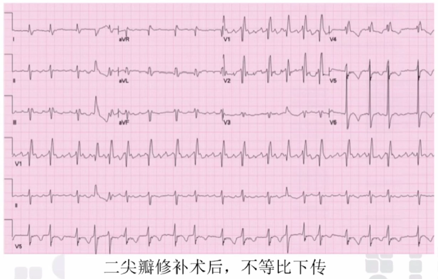 心律解码丨心房扑动的心电图特点及治疗