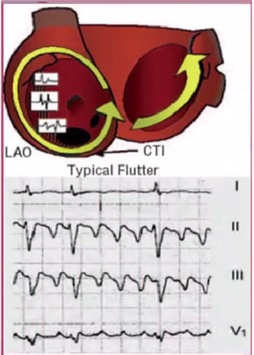 心律解码丨心房扑动的心电图特点及治疗