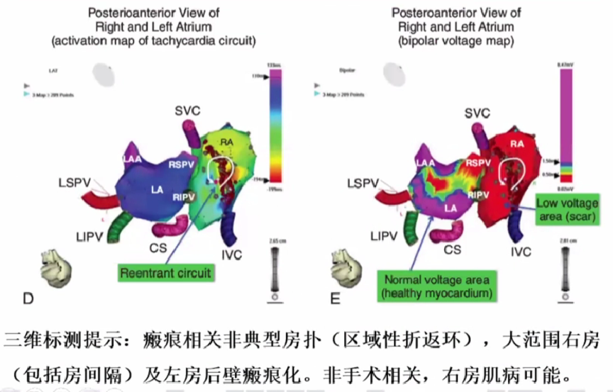 心律解码丨心房扑动的心电图特点及治疗