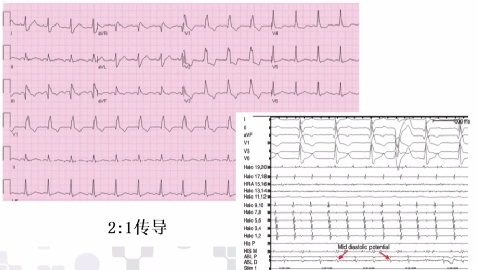 心律解码丨心房扑动的心电图特点及治疗