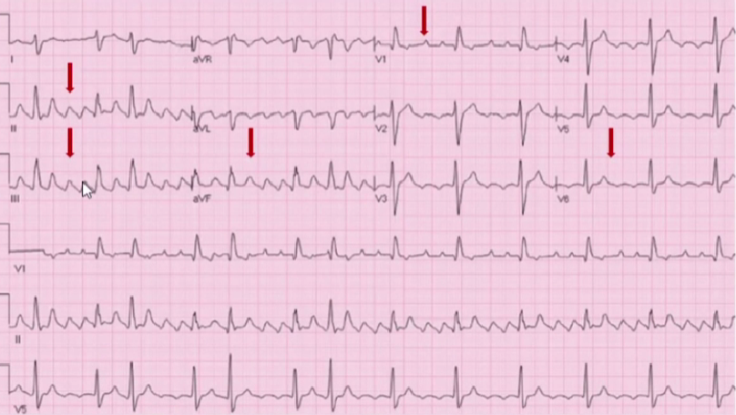 心律解码丨心房扑动的心电图特点及治疗